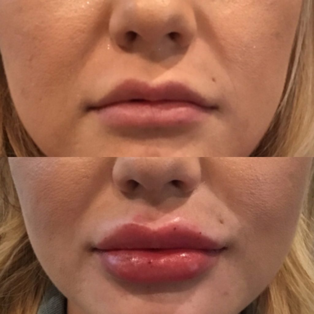 Lip Filler Photos Roseville Before & After Lip Lift