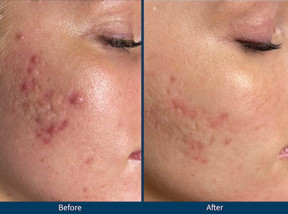 Microneedling Folsom