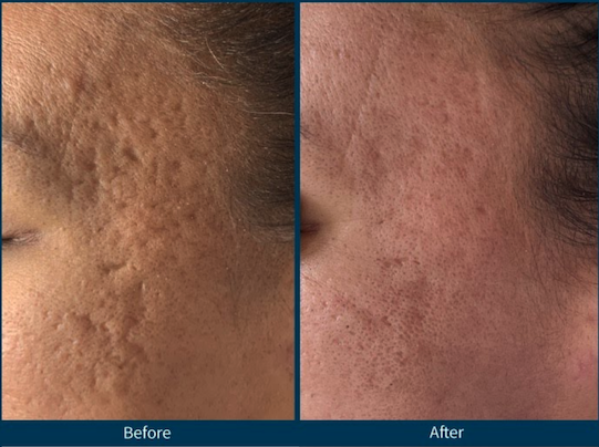 Microneedling Rocklin