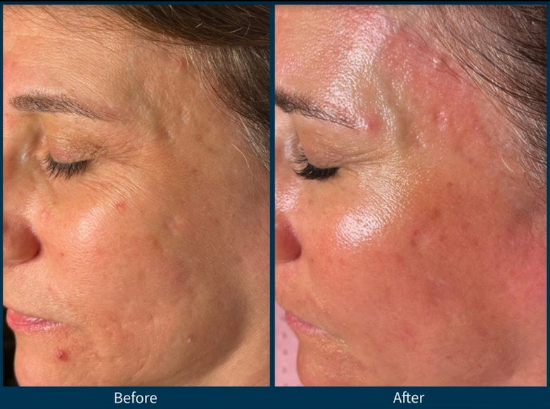 Microneedling results Roseville