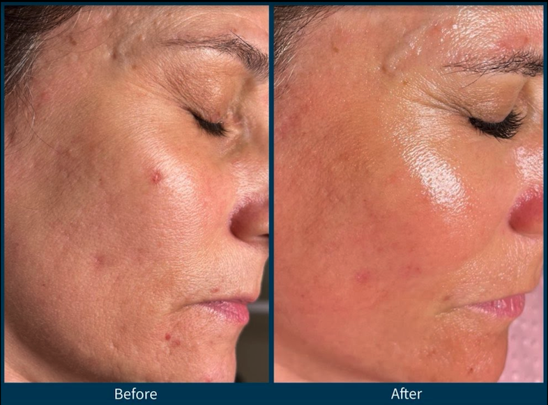 Microneedling treatment Lincoln